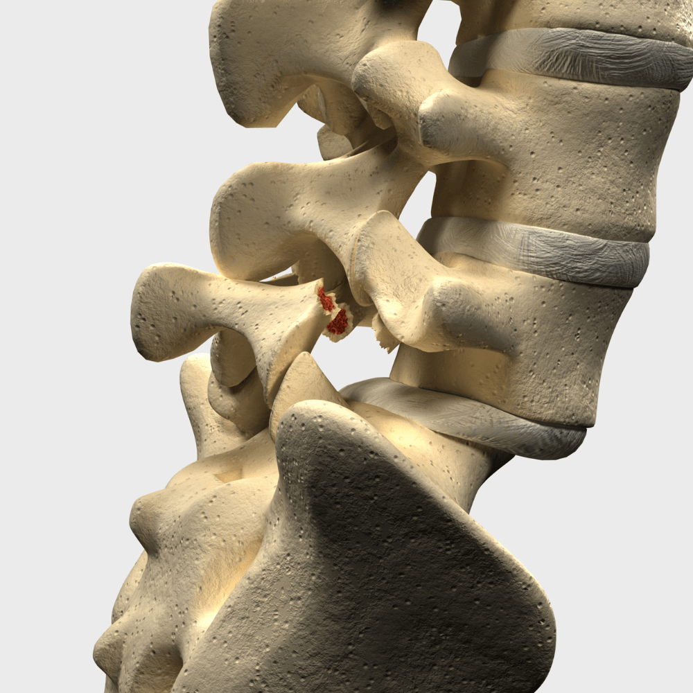 spondylolisthesis