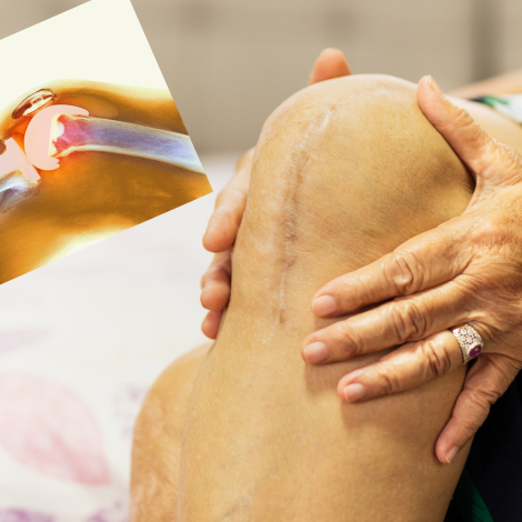 Quadriceps Strength and the Functional Recovery After Total Knee Arthroplasty